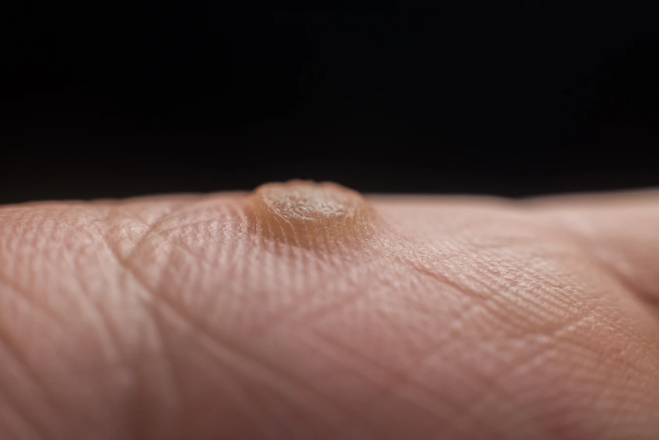 Co dobrego na kurzajki dla dzieci?