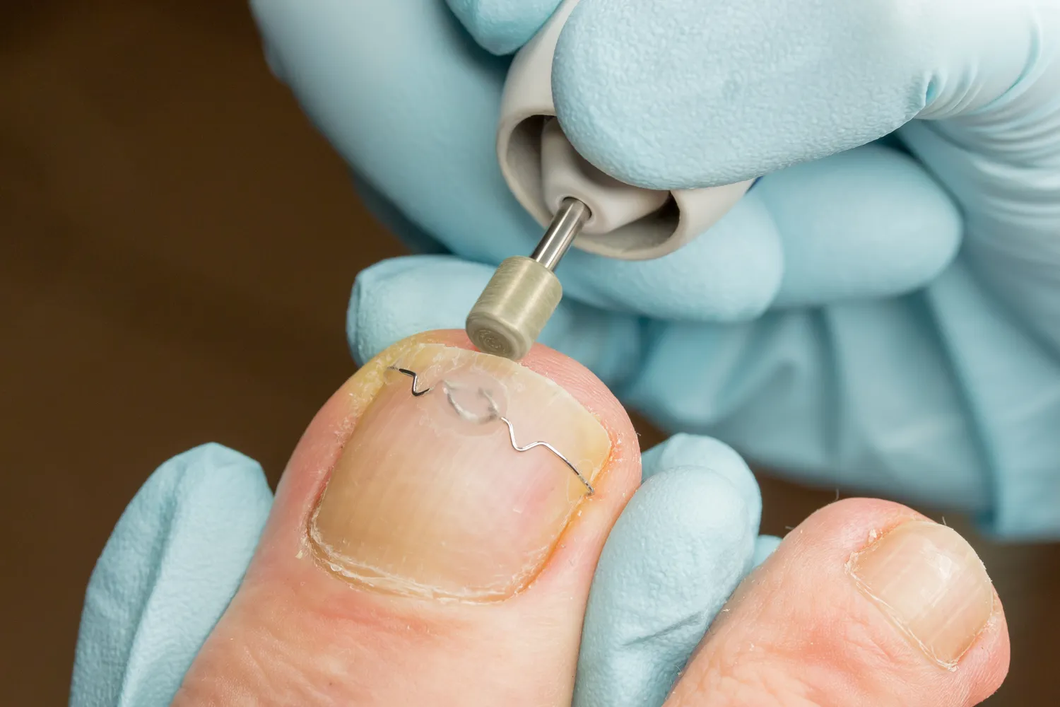  Jak podolog leczy grzybice paznokci?